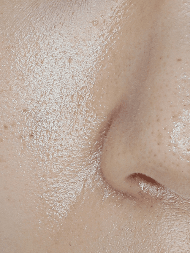 [30대 초반] 10회 시술 Before