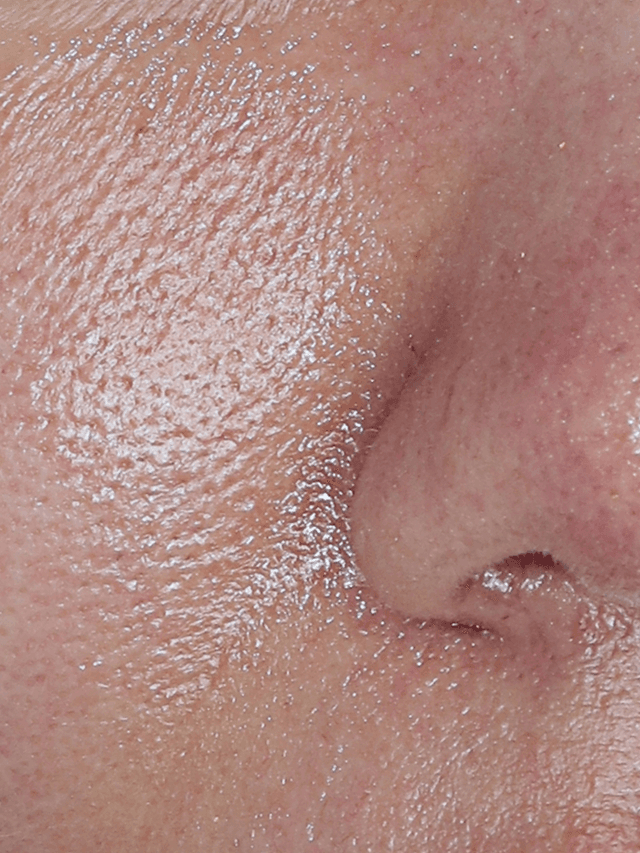 [30대 중반] 5회 시술 Before