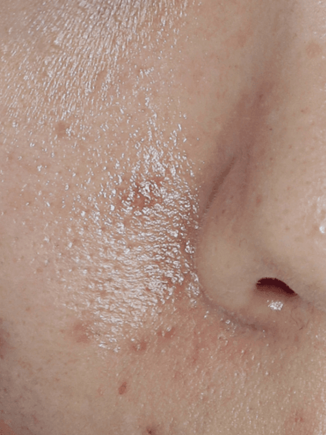 [20대 중반] 10회 시술 Before