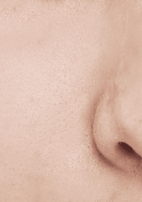 [30대 후반] 10회 시술 After