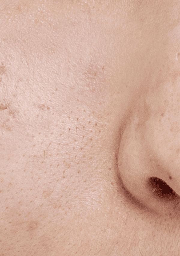 [30대 후반] 10회 시술 Before