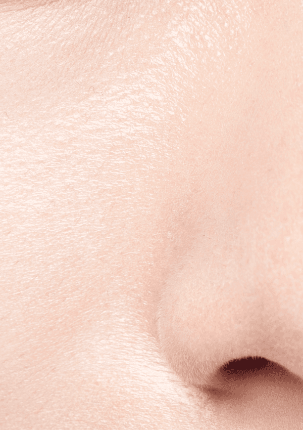 [20대 초반] 5회 시술 After