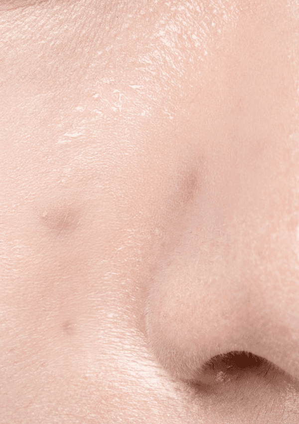 [20대 초반] 5회 시술 Before