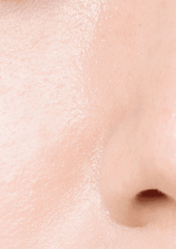 [20대 중반] 5회 시술 After