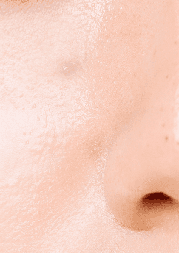 [20대 중반] 5회 시술 Before