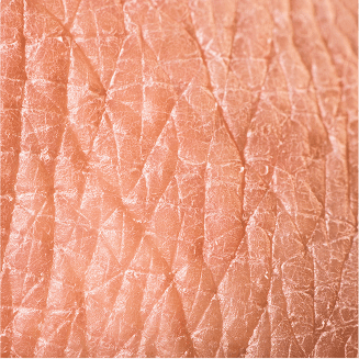 건조한/거친 피부