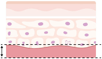 조직 - 재생층 (진피)